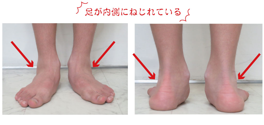 扁平足のまま成長してしまった足