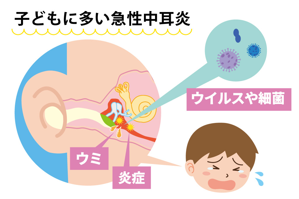 子どもに多い急性中耳炎